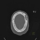 Myeloma of orbit and skull: CT - Computed tomography